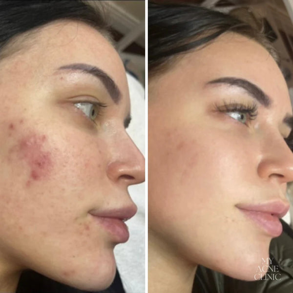 Lipo-Ex Serum – Ausgleichendes Serum für unreine & unruhige Haut (15 ml)