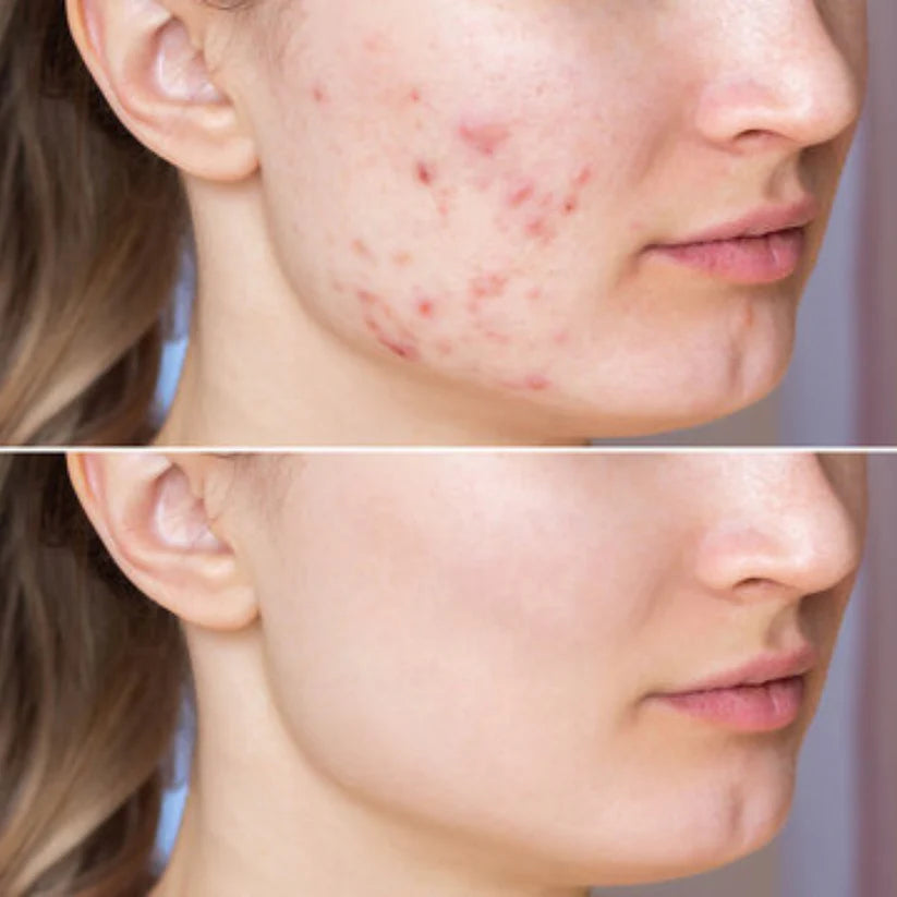 Lipo-Ex Serum – Ausgleichendes Serum für unreine & unruhige Haut (15 ml)