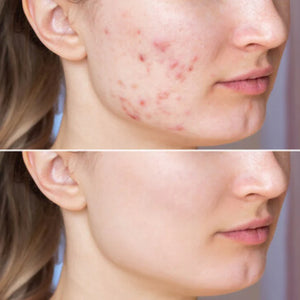 Lipo-Ex Serum – Ausgleichendes Serum für unreine & unruhige Haut (15 ml)