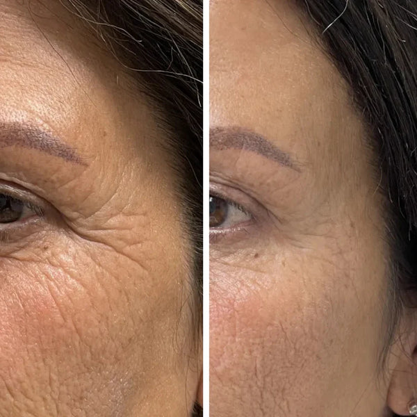 Hyaluron Filler für spürbar bessere Haut (20 ml)